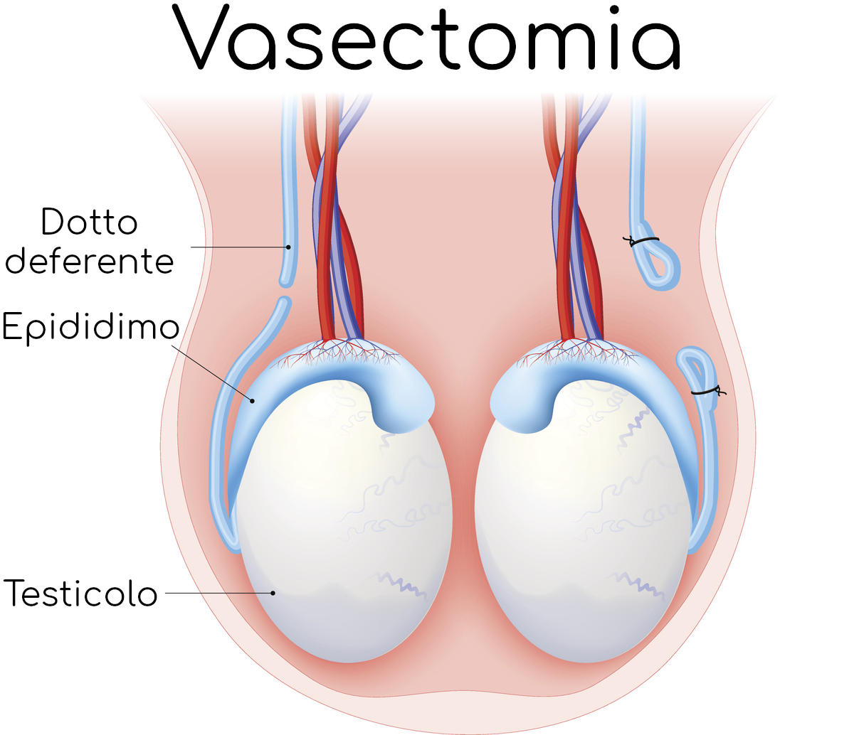 Vasectomia