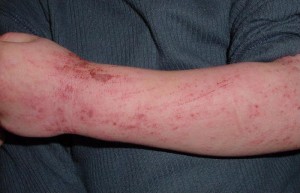 Dermatite atopica Dermatite atopica (http://commons.wikimedia.org/wiki/File:Atopic_dermatitis_child.JPG)