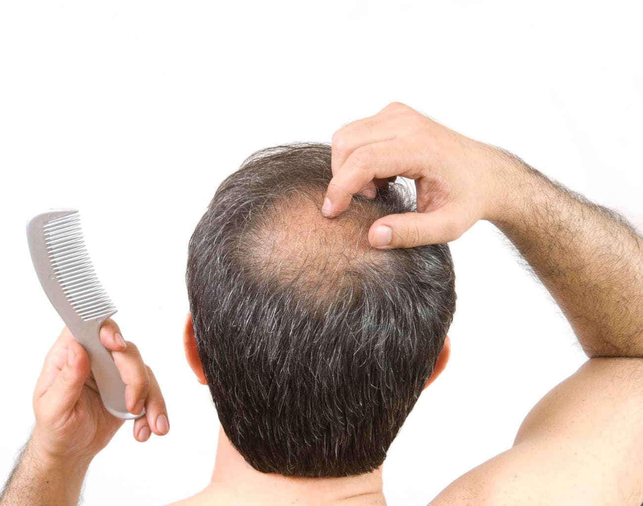 Alopecia androgenetica in un uomo