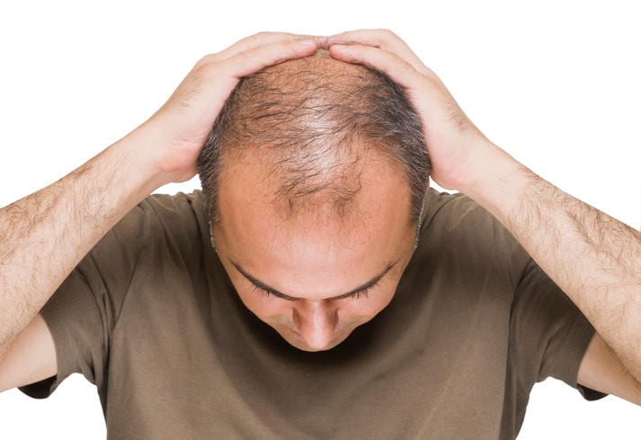 Fotografia dall'alto di un uomo con alopecia androgenetica (calvizie)