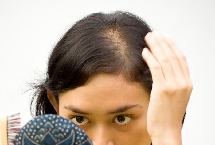Particolare di alopecia androgenetica nella donna.