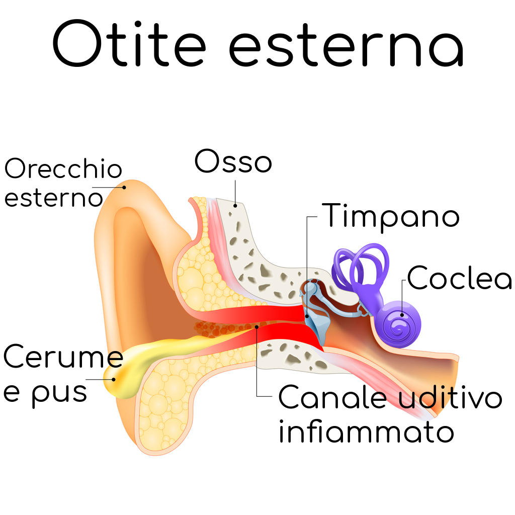 Schematizzazione dell'otite esterna