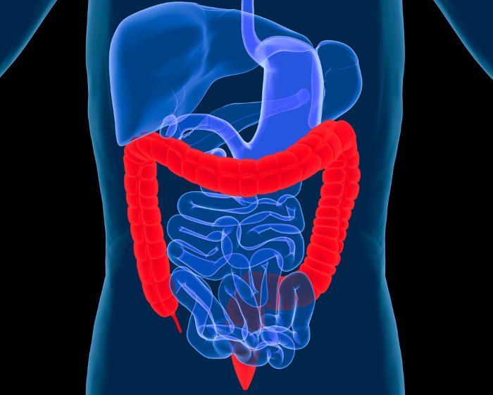 Rappresentazione grafica della porzione di intestino interessata dalla rettocolite ulcerosa.