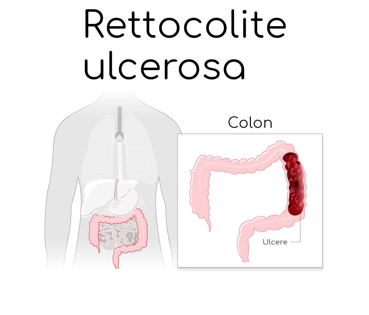 Rettocolite ulcerosa, in evidenza la posizione anatomica del colon