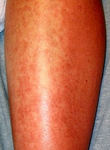 Orticaria da antibiotico (https://en.wikipedia.org/wiki/File:Urticaria_2.jpg)