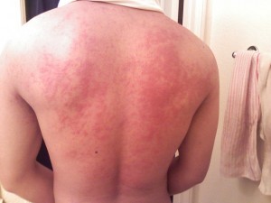 Orticaria sulla schiena (https://en.wikipedia.org/wiki/File:Hives_on_back.jpg)