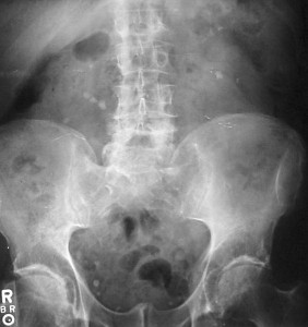 Radiografia con calcoli (https://en.wikipedia.org/wiki/File:Kidney_stones_abdominal_X-ray.jpg)
