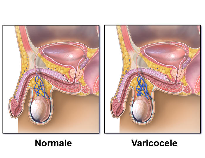 Ricostruzione grafica dell'anatomia del varicocele