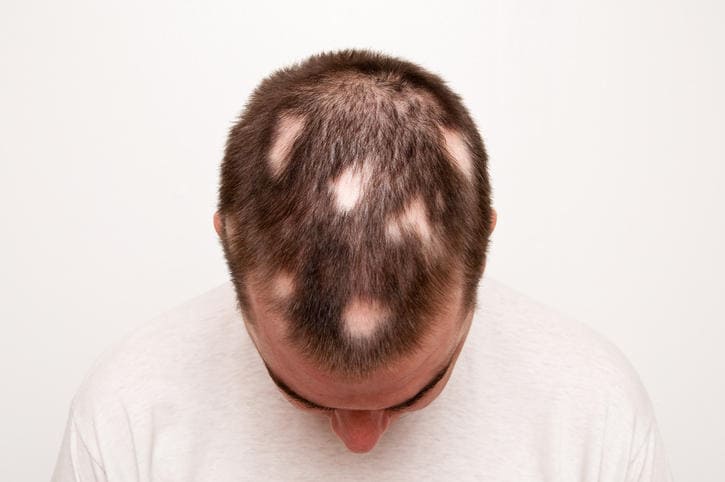 Fotografia di esempio di uomo affetto da alopecia areata