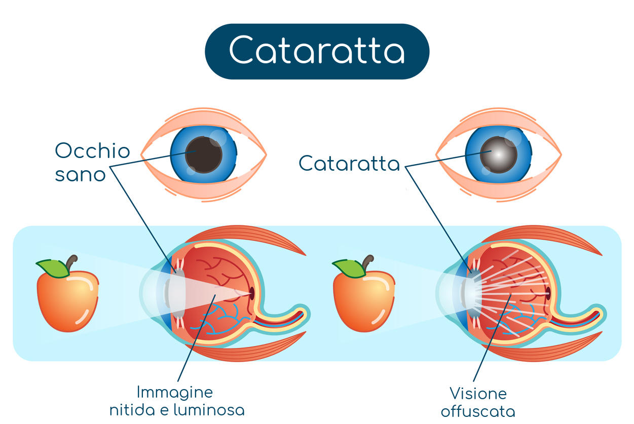 Esemplificazione grafica della cataratta
