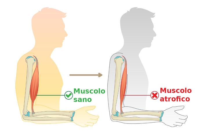Rappresentazione grafica dell'atrofia muscolare