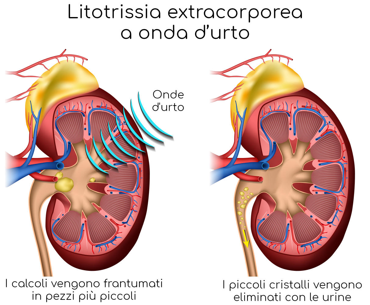 Litotrissia extracorporea ad onde d'urto