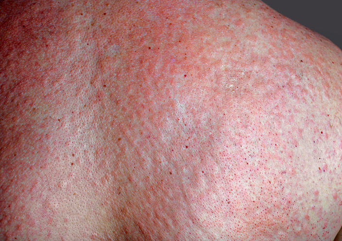 Fotografia di orticaria sulla schiena