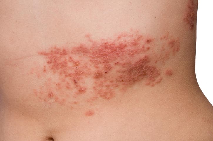 Immagine della tipica eruzione cutanea dello zoster sulla pancia