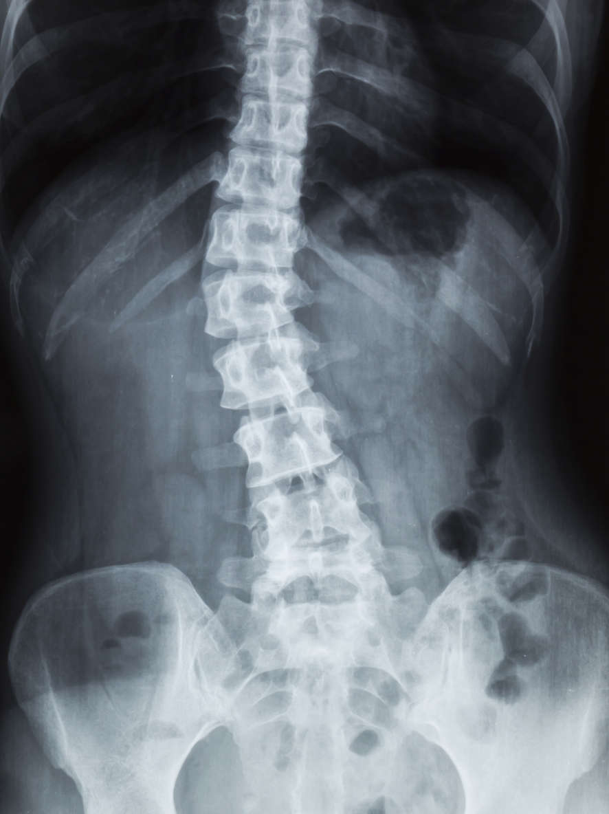 Radiografia di una colonna vertebrale affetta da scoliosi