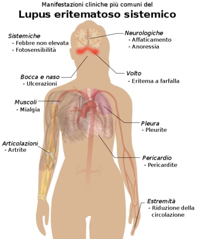 Immagine riassuntiva con i sintomi del lupus
