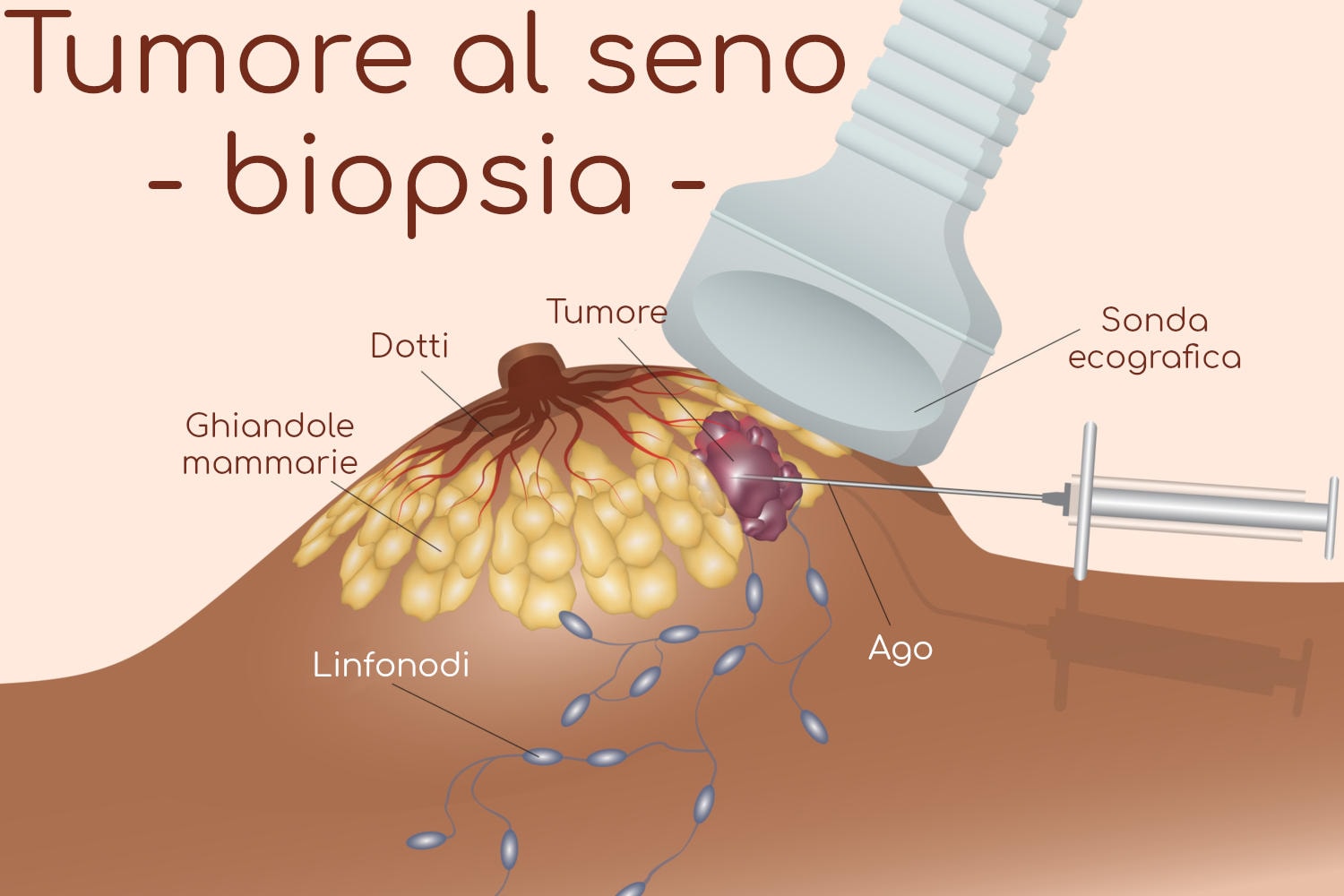 Schematizzazione del processo di biopsia del tumore al seno