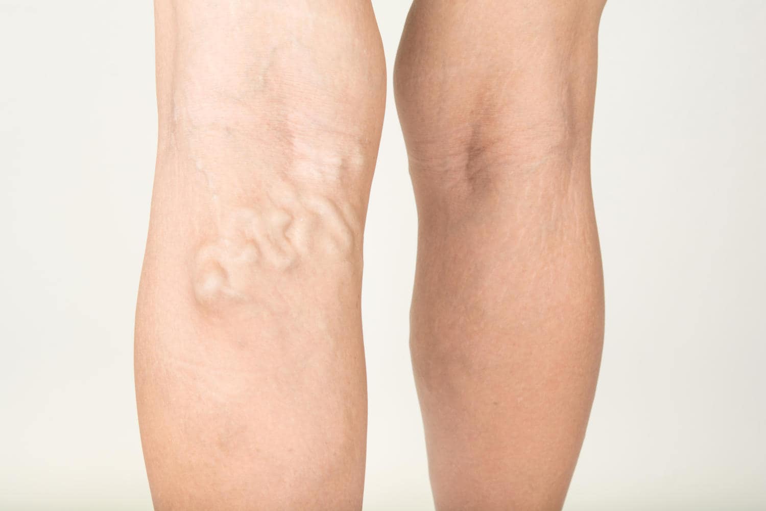 Vene varicose nelle gambe