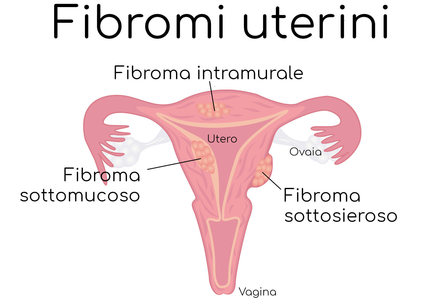 Diverse tipologie di fibromi uterini