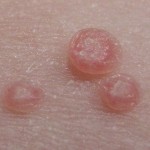 Mollusco contagioso, papule (https://it.wikipedia.org/wiki/File:Molluscaklein.jpg)