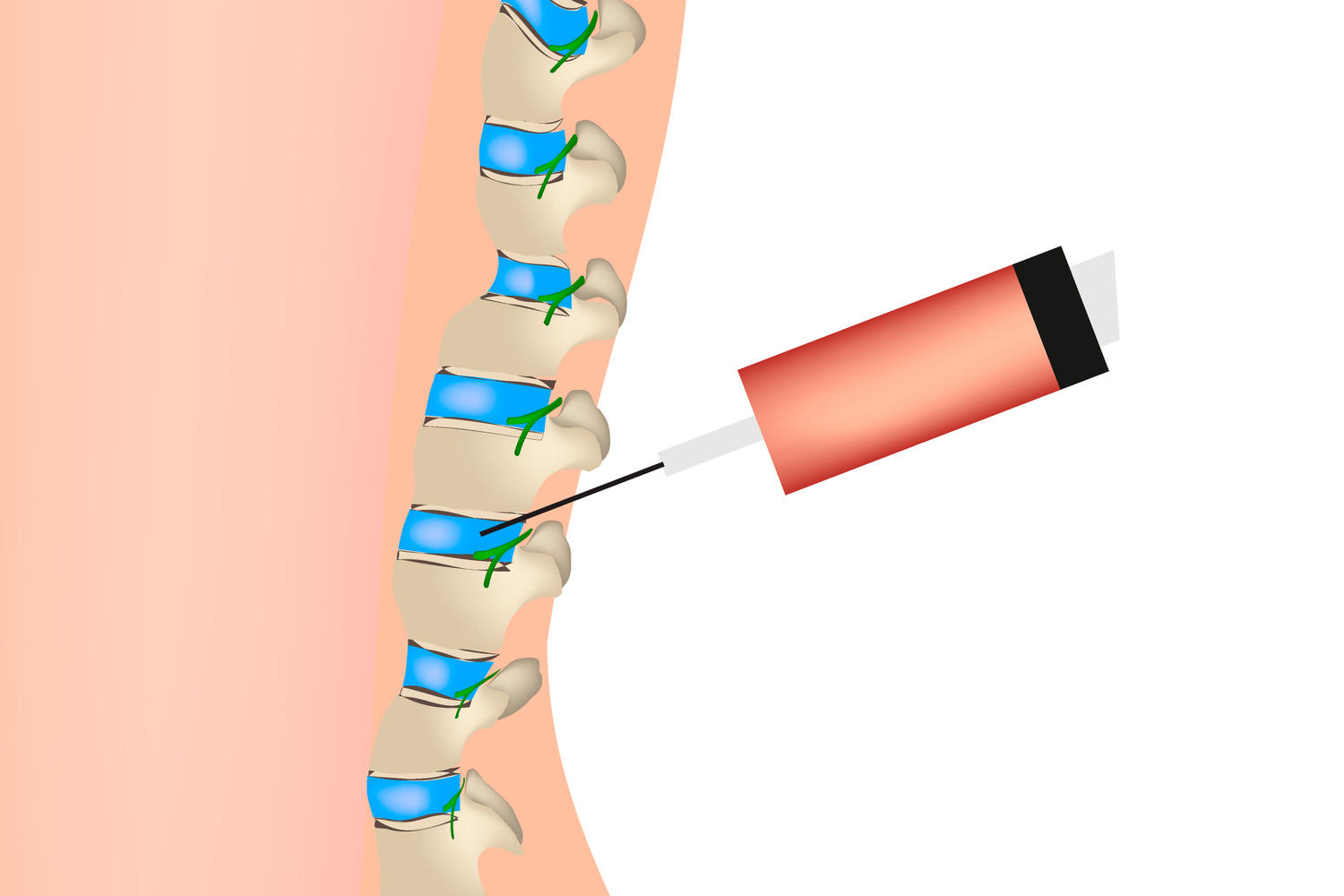 Ago epidurale ed iniezione