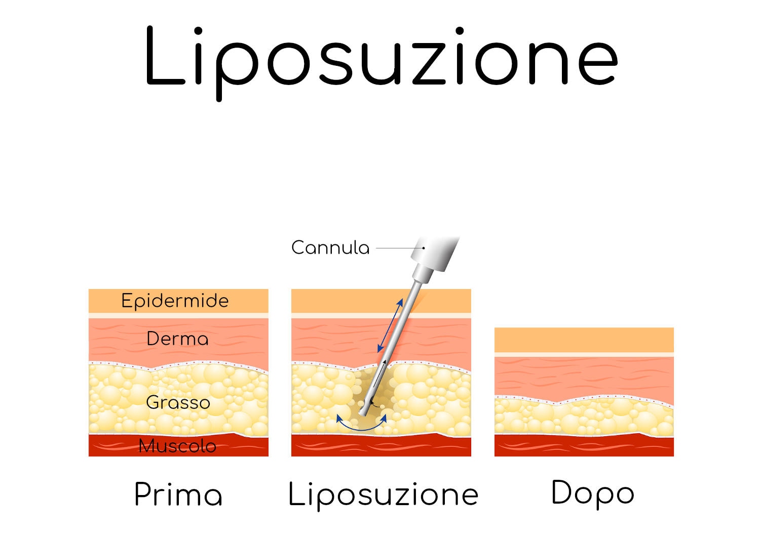 Strati della pelle e liposuzione