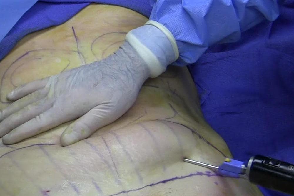 Fotografia della cannula per liposuzione inserita nell'addome della paziente