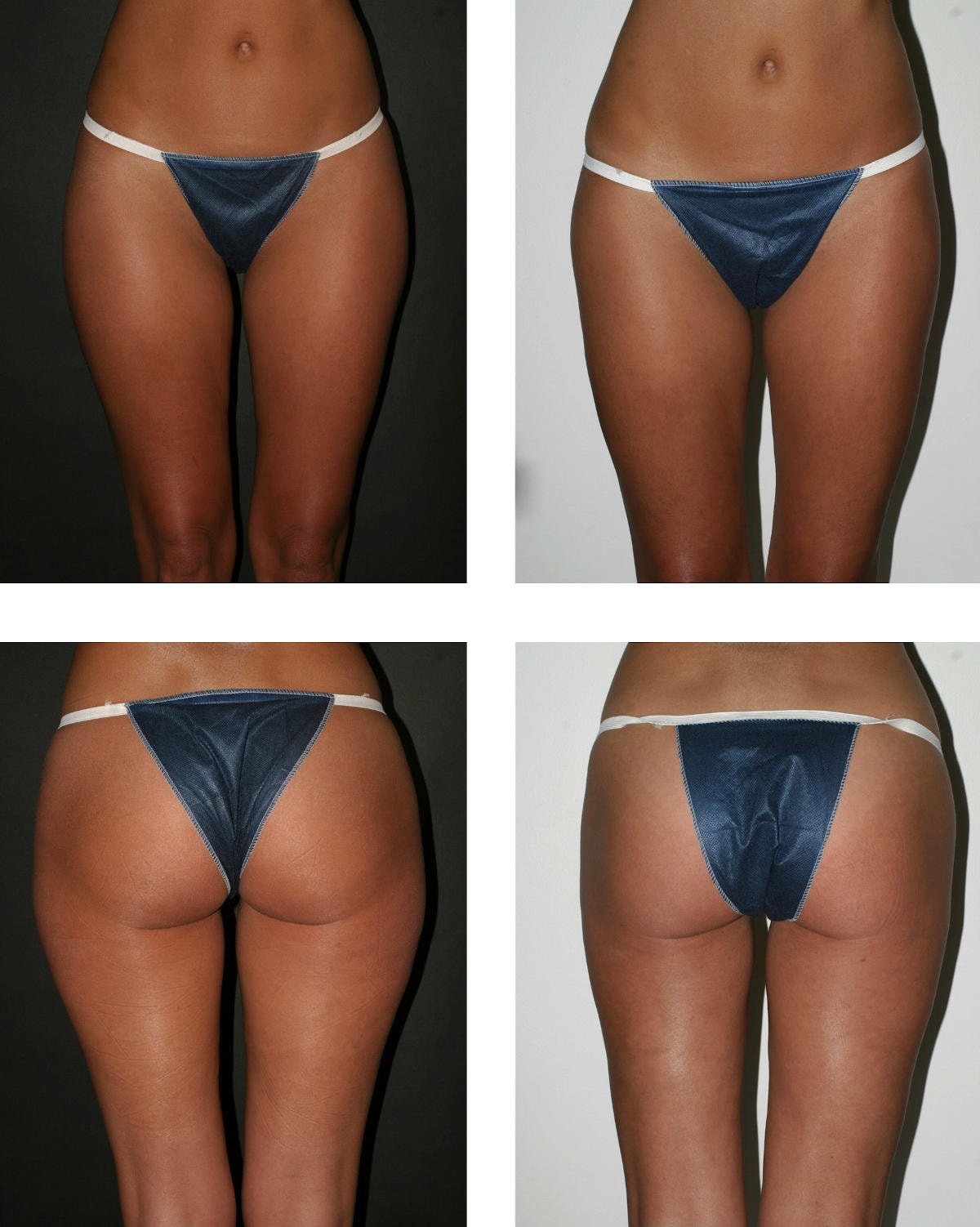Risultati della liposuzione (fotografia di confronto prima e dopo)