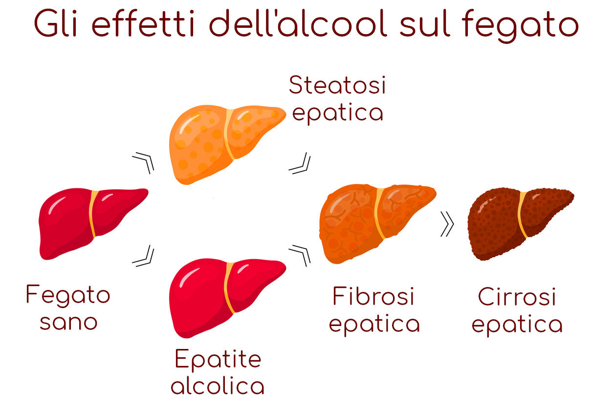 Meccanismi di progressione dei danni degli alcolici sul fegato