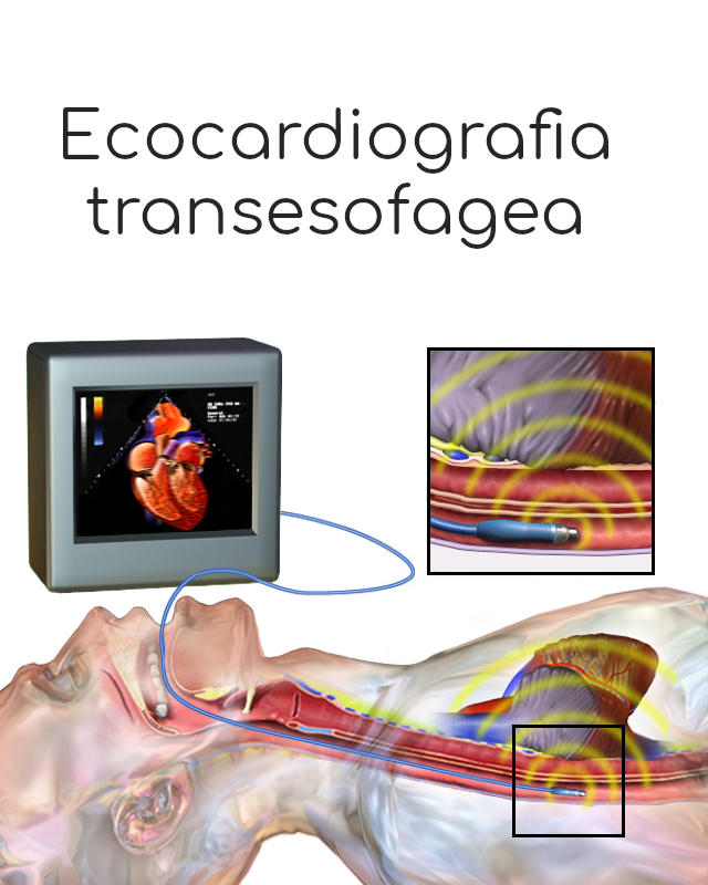 Ecocardiografia transesofagea