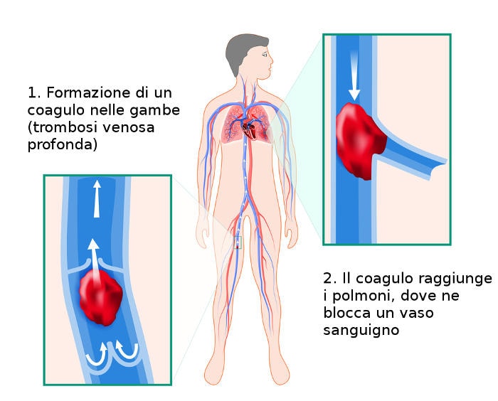 Rappresentazione grafica del meccanismo alla base dell'embolia polmonare
