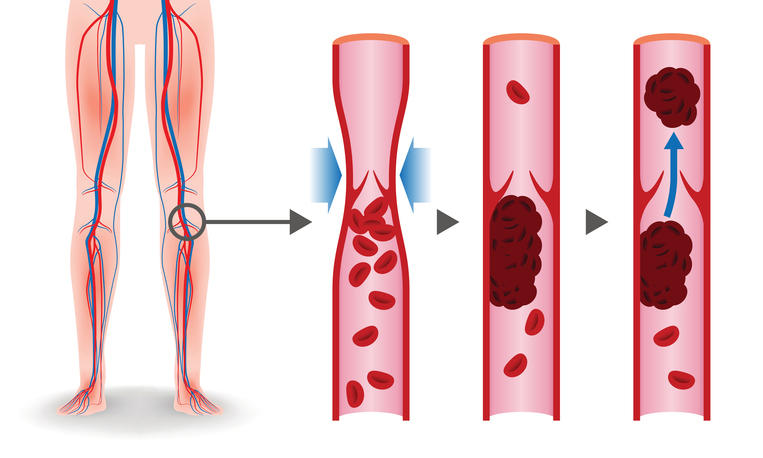 Schematizzazione grafica di una trombosi alle gambe