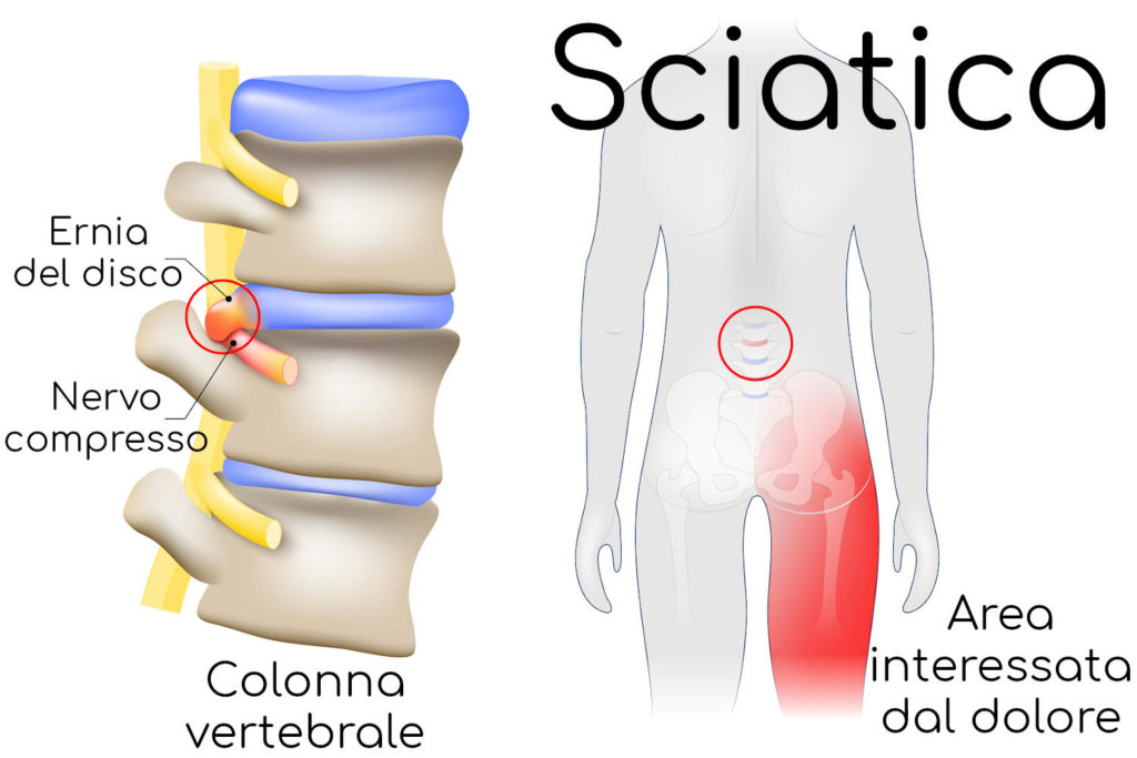 MODELLO DISCO INTERVERTEBRALE ernia lombare ingrandimento colonna vertebrale 1,5X anatomico EUR