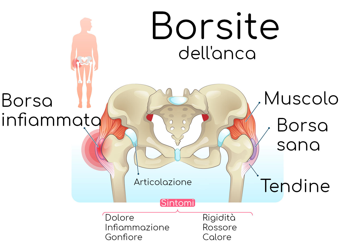 Anatomia semplificata della borsite dell'anca