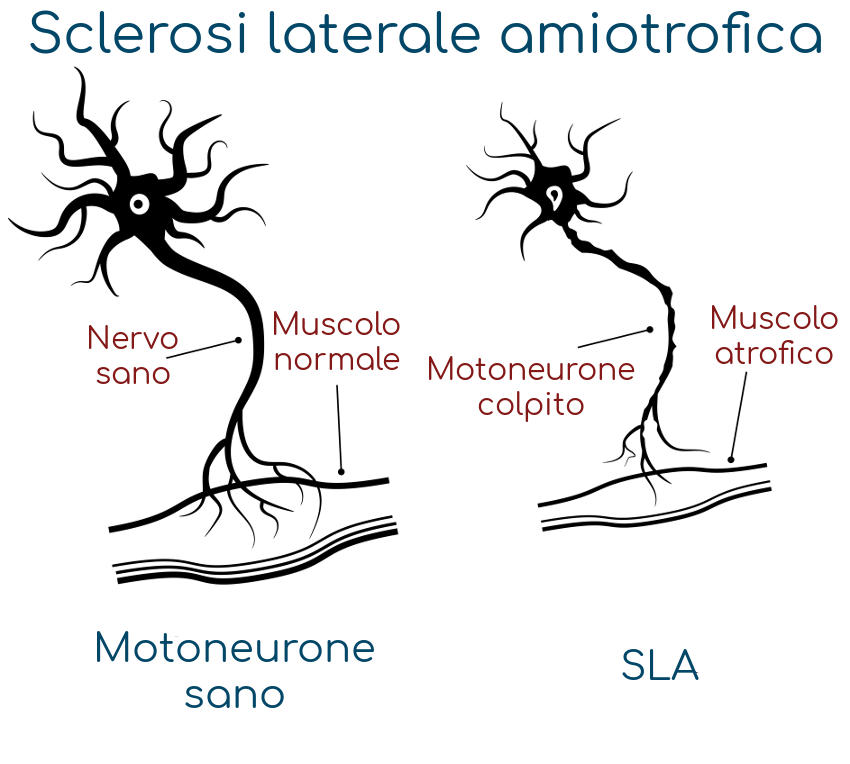 Schematizzazione della malattia del motoneurone