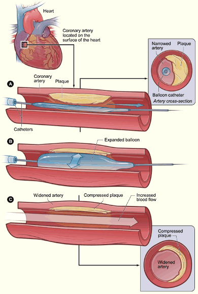 Angioplastica con catere a palloncino