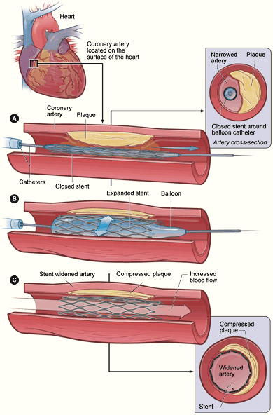 Angioplastica con stent