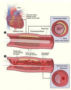 Restenosi da Stent