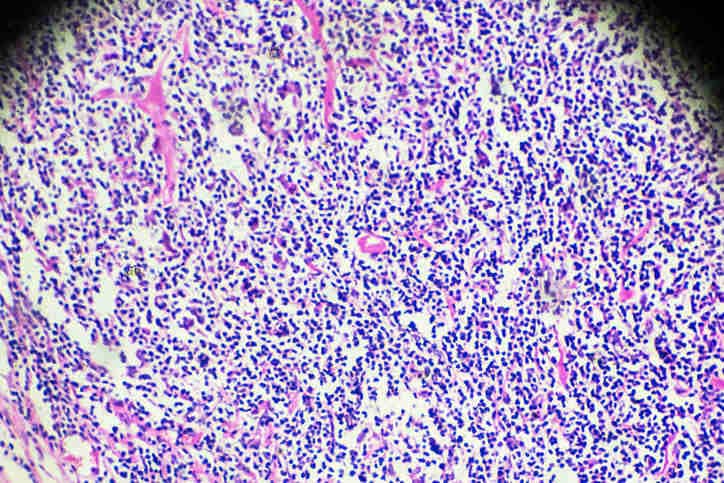 Immagine istopatologica del linfoma, al microscopio