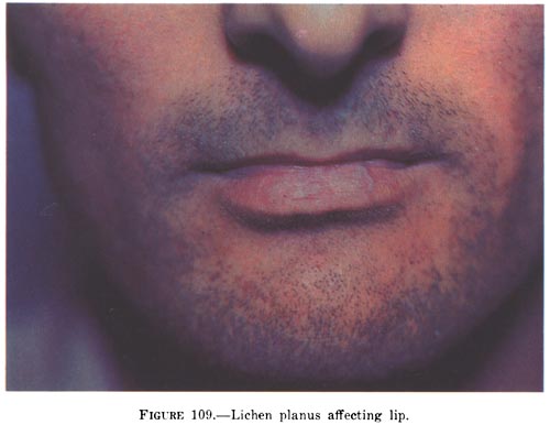 Lichen Planus Bocca Lichen Planus Bocca