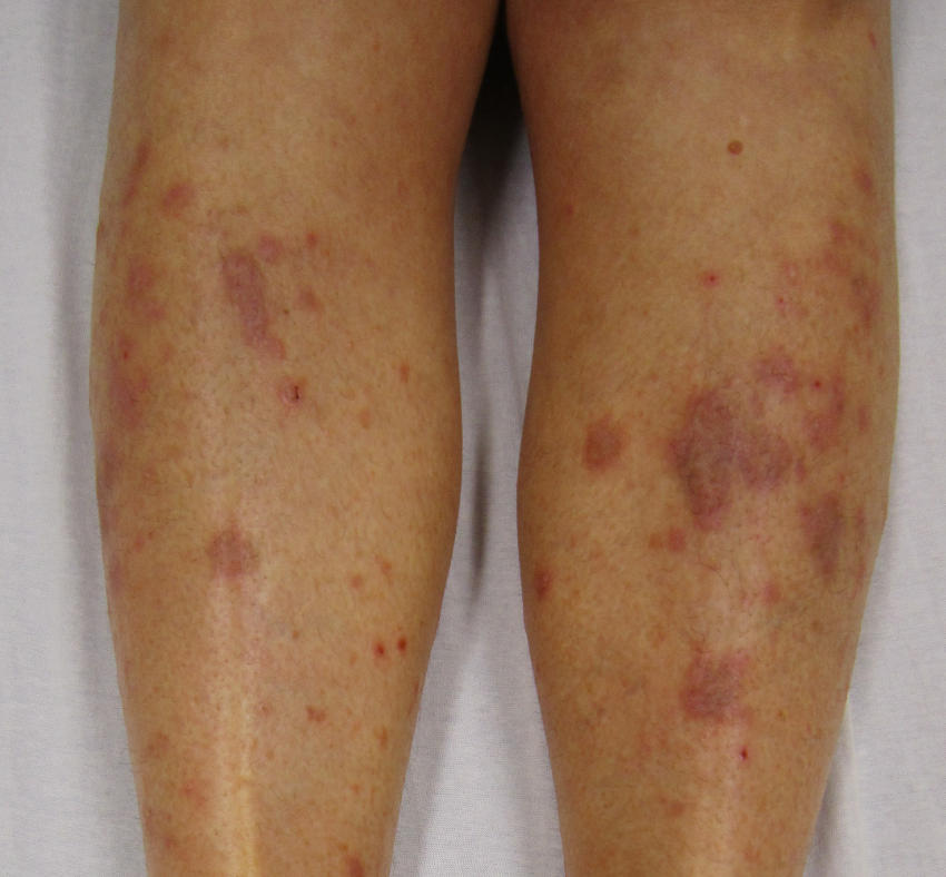 Lichen planus sulle gambe