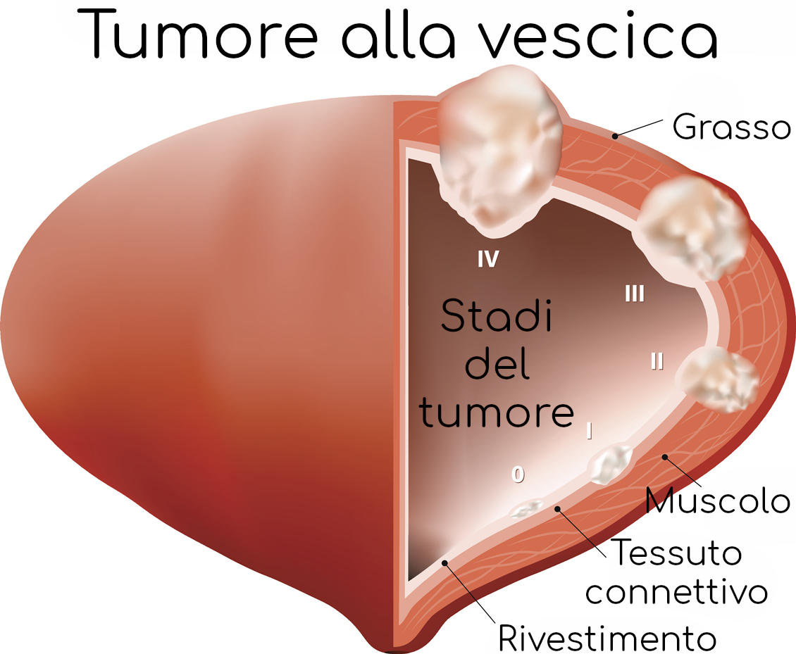 Stadi del tumore alla vescica