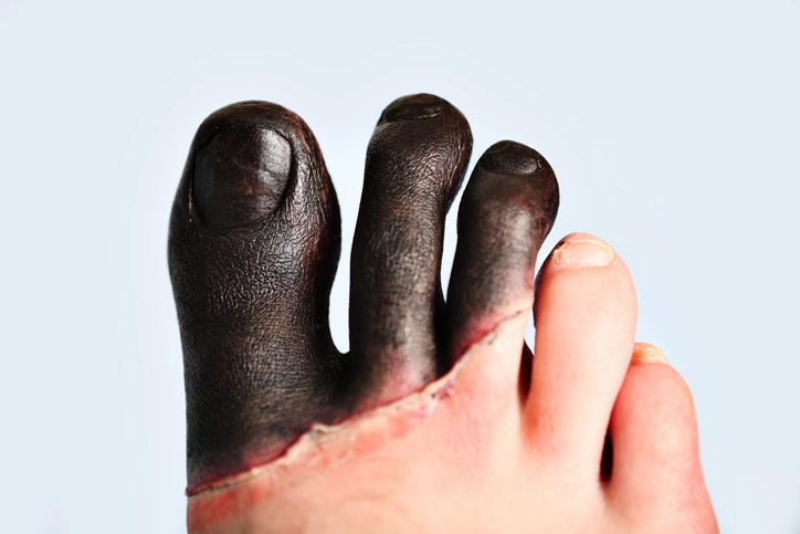 Geloni di terzo grado ai piedi