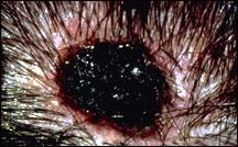 Bordo melanoma