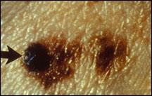 Colore melanoma