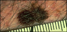 Dimensione melanoma