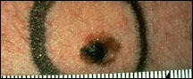 Pelle attorno al melanoma