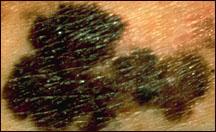Sensazione melanoma
