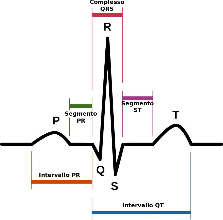 Rappresentazione schematica del tracciato ECG della sindrome del QT lungo.