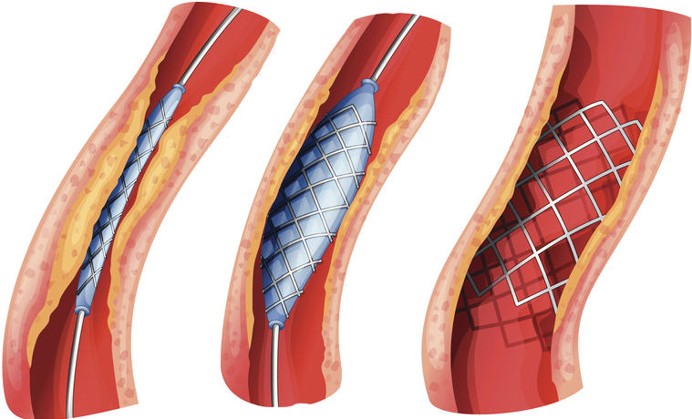 Rappresentazione grafica del posizionamento di uno stent